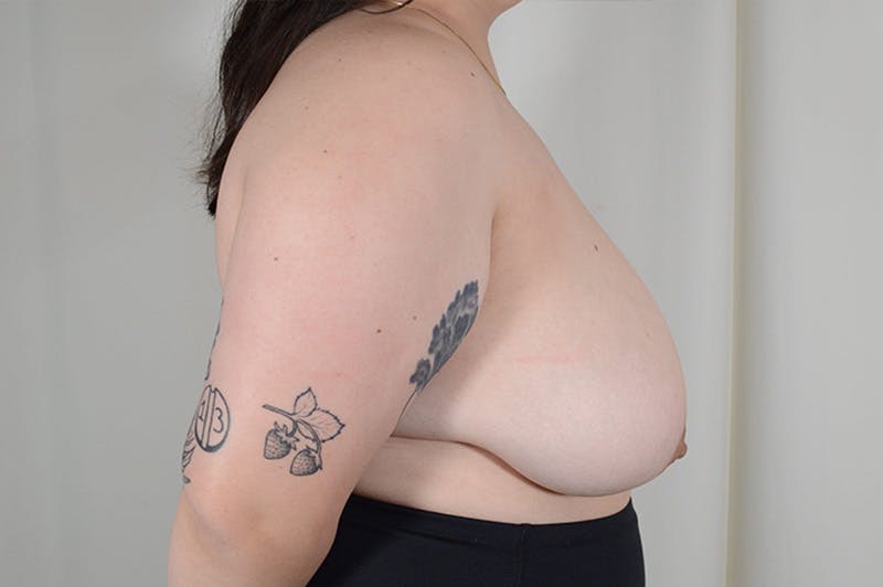 Breast Reduction Before & After Gallery - Patient 166633 - Image 5