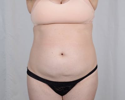 Tummy Tuck Before & After Gallery - Patient 223504 - Image 1