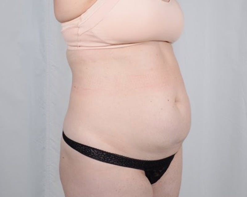 Tummy Tuck Before & After Gallery - Patient 223504 - Image 3