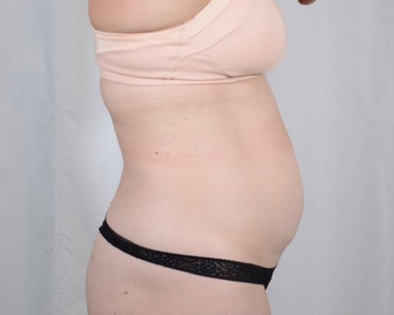 Tummy Tuck Before & After Gallery - Patient 223504 - Image 5