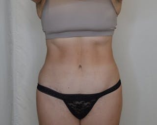 Tummy Tuck Before & After Gallery - Patient 223504 - Image 2