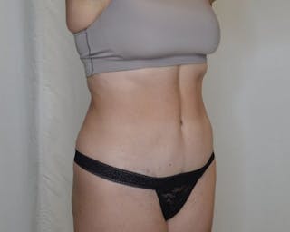 Tummy Tuck Before & After Gallery - Patient 223504 - Image 4