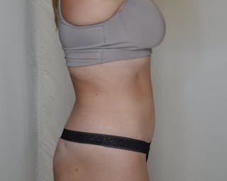 Tummy Tuck Before & After Gallery - Patient 223504 - Image 6