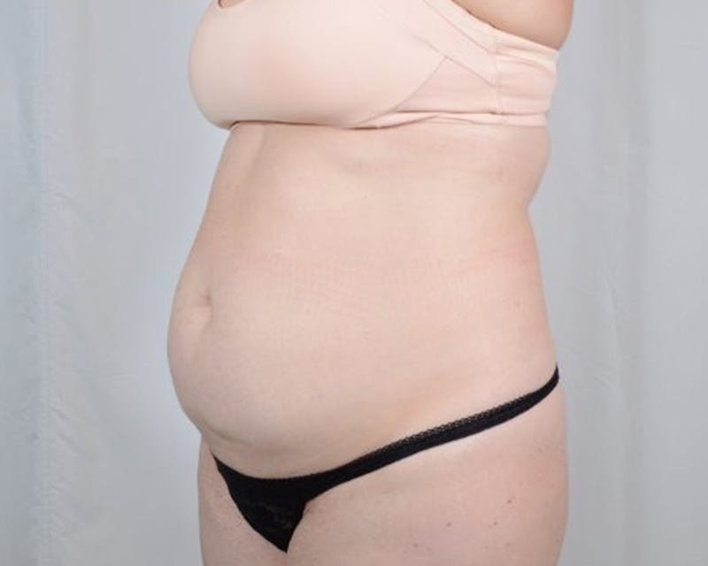 Tummy Tuck Before & After Gallery - Patient 223504 - Image 7