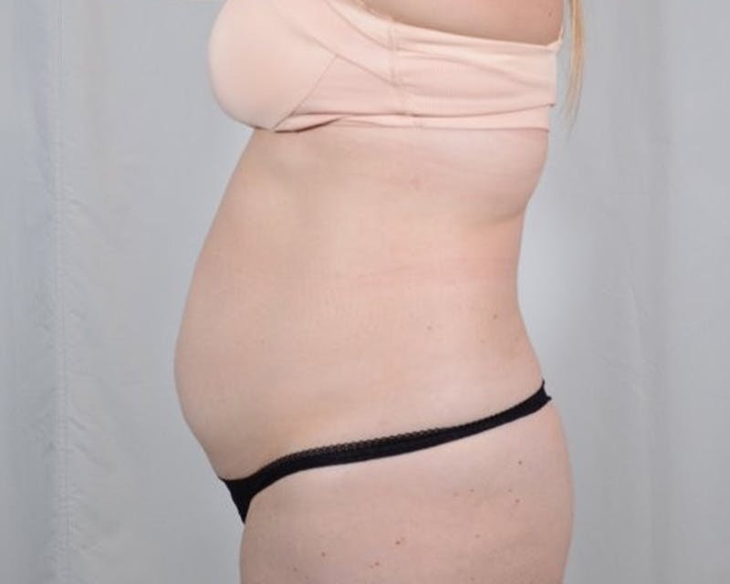 Tummy Tuck Before & After Gallery - Patient 223504 - Image 9