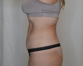 Tummy Tuck Before & After Gallery - Patient 223504 - Image 10
