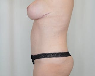 Tummy Tuck Before & After Gallery - Patient 346833 - Image 4