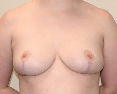 Breast Reduction Before & After Gallery - Patient 183130 - Image 2