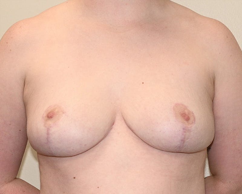 Breast Reduction Before & After Gallery - Patient 183130 - Image 2