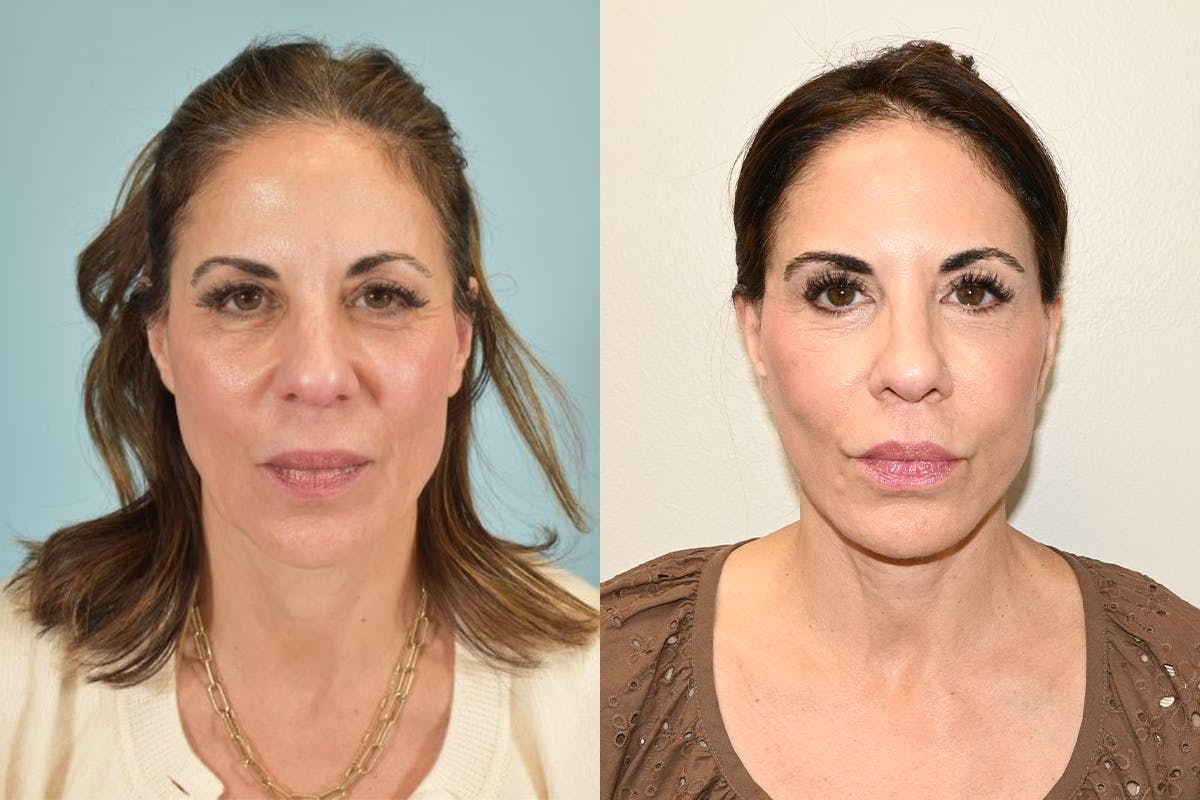 Facelift Before & After Gallery - Patient 492338 - Image 1