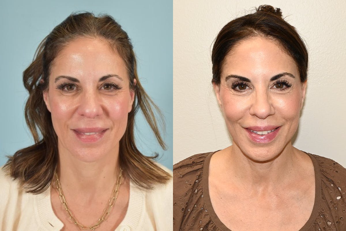 Facelift Before & After Gallery - Patient 492338 - Image 2