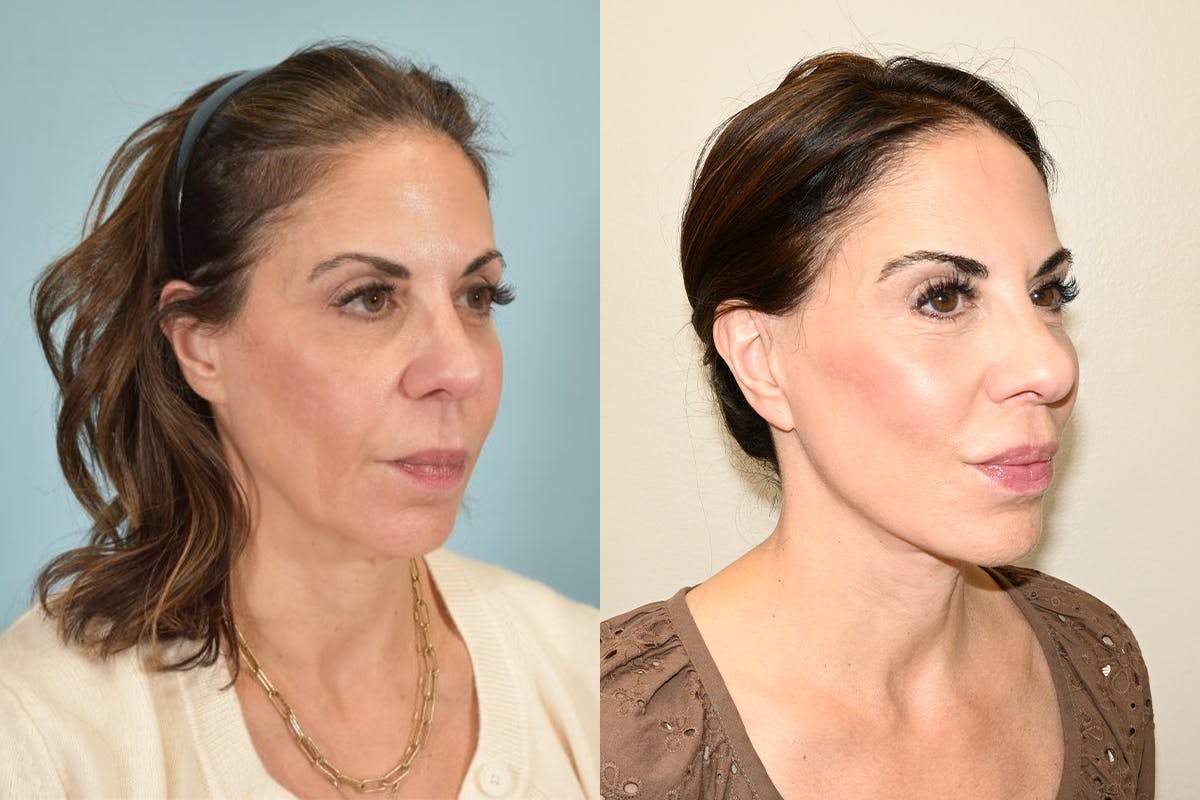 Facelift Before & After Gallery - Patient 492338 - Image 3