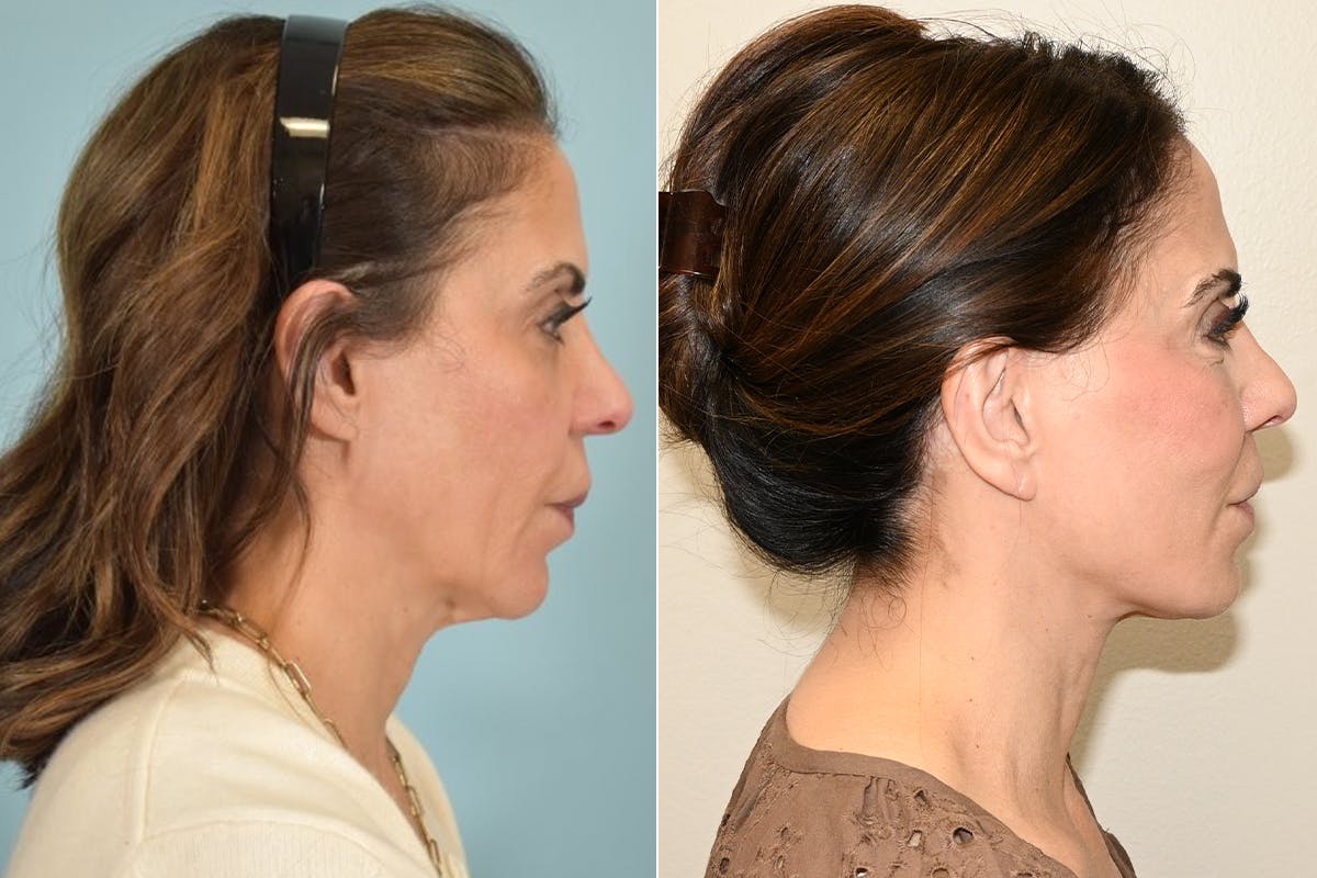 Facelift Before & After Gallery - Patient 492338 - Image 4
