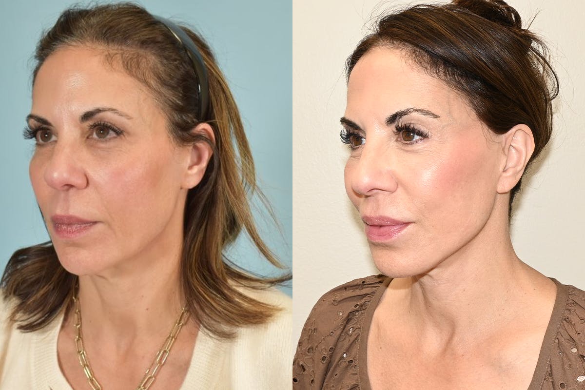 Facelift Before & After Gallery - Patient 492338 - Image 6