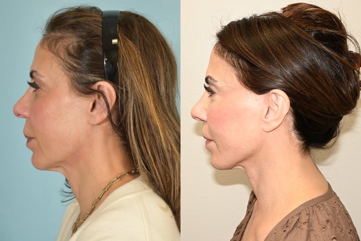 Facelift Before & After Gallery - Patient 492338 - Image 5