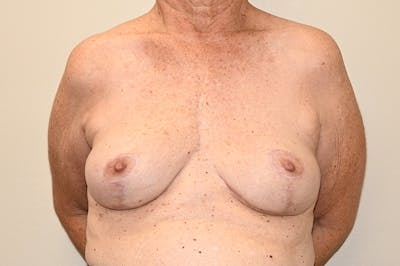 Explant Before & After Gallery - Patient 471934 - Image 2