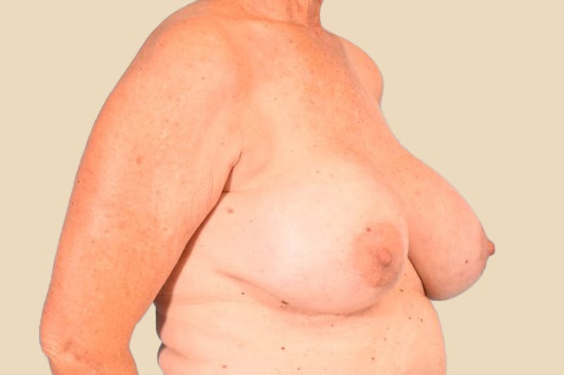 Explant Before & After Gallery - Patient 471934 - Image 3