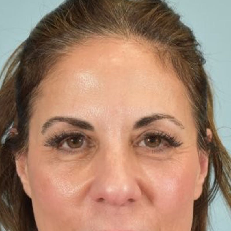 Blepharoplasty Before & After Gallery - Patient 360613 - Image 1