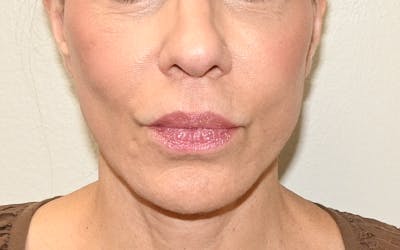 Lip Lift Before & After Gallery - Patient 249355 - Image 2