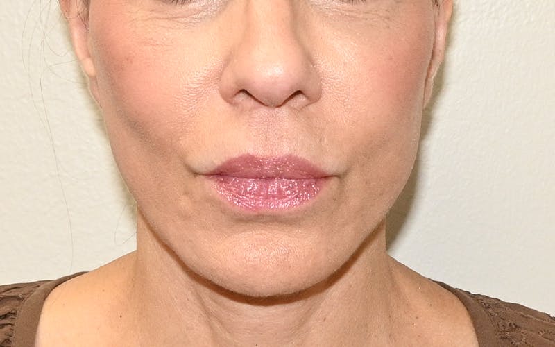 Lip Lift Before & After Gallery - Patient 249355 - Image 2