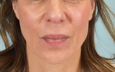 Lip Lift Before & After Gallery - Patient 249355 - Image 1