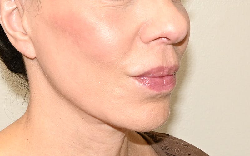 Lip Lift Before & After Gallery - Patient 249355 - Image 4