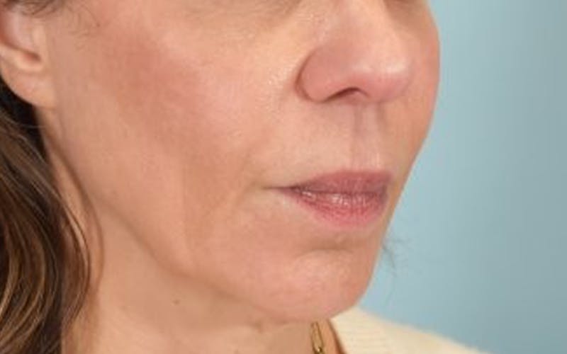 Lip Lift Before & After Gallery - Patient 249355 - Image 3