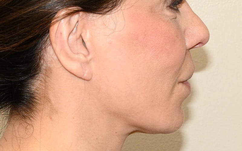 Lip Lift Before & After Gallery - Patient 249355 - Image 6