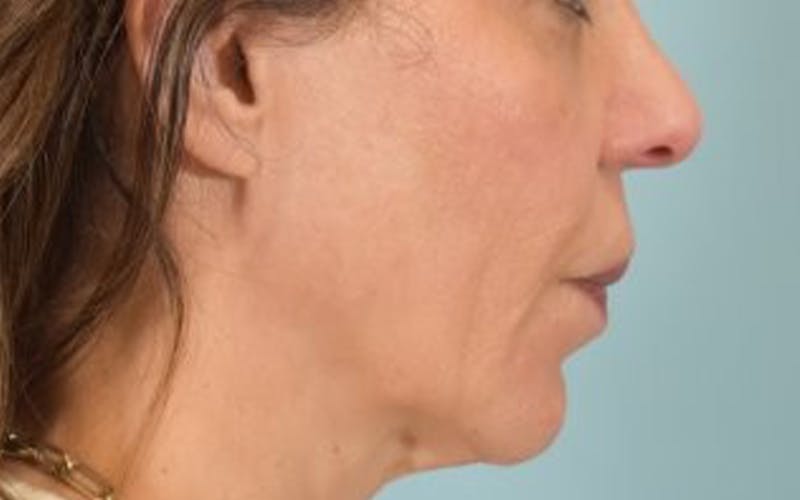 Lip Lift Before & After Gallery - Patient 249355 - Image 5