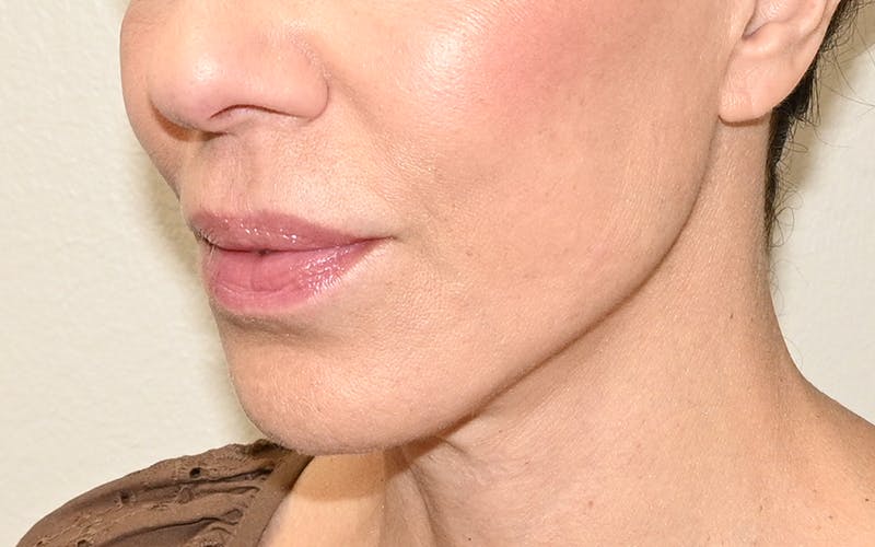 Lip Lift Before & After Gallery - Patient 249355 - Image 8