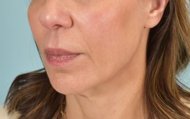 Lip Lift Before & After Gallery - Patient 249355 - Image 7