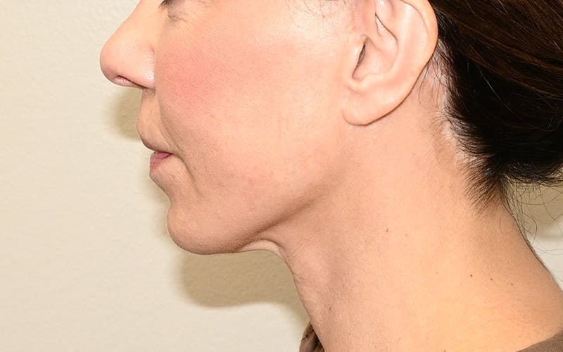 Lip Lift Before & After Gallery - Patient 249355 - Image 10