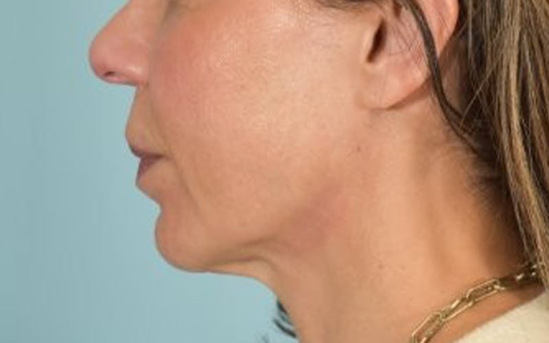 Lip Lift Before & After Gallery - Patient 249355 - Image 9