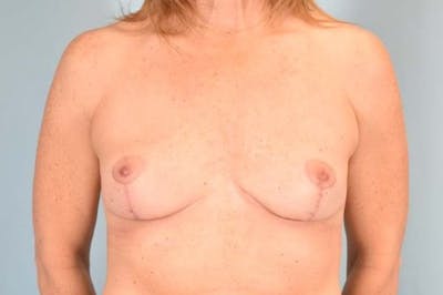 Explant Before & After Gallery - Patient 311024 - Image 2