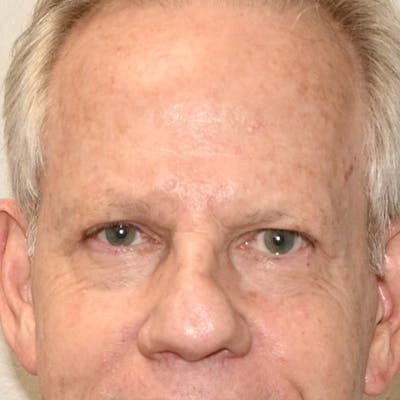 Blepharoplasty Before & After Gallery - Patient 204537 - Image 2