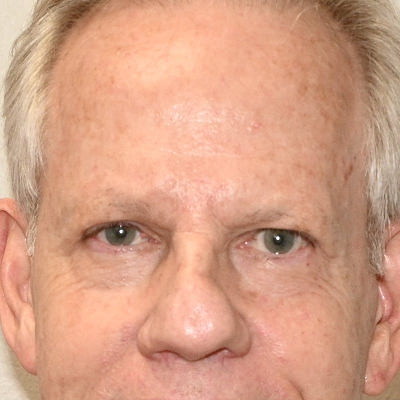 Blepharoplasty Before & After Gallery - Patient 204537 - Image 2