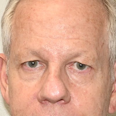 Blepharoplasty Before & After Gallery - Patient 204537 - Image 1
