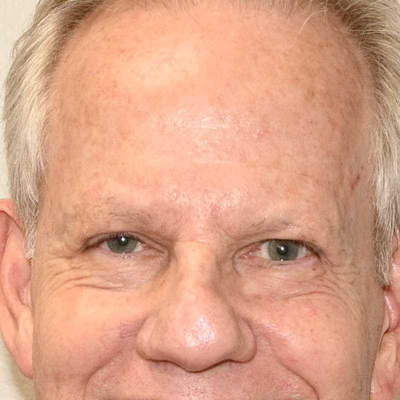 Blepharoplasty Before & After Gallery - Patient 204537 - Image 4