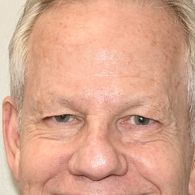 Blepharoplasty Before & After Gallery - Patient 204537 - Image 3