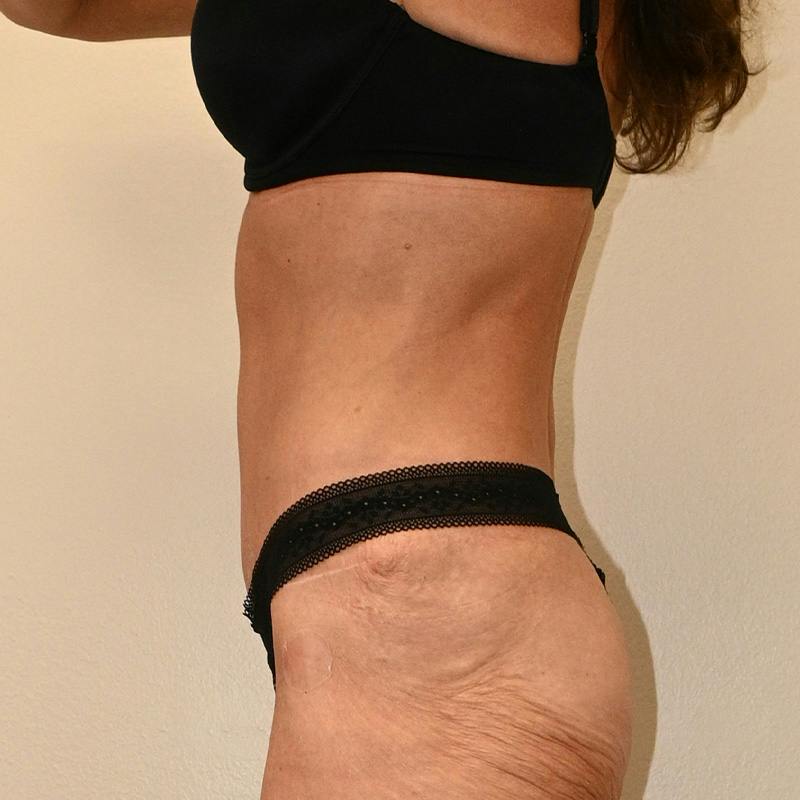 Body Lift Before & After Gallery - Patient 796213 - Image 3