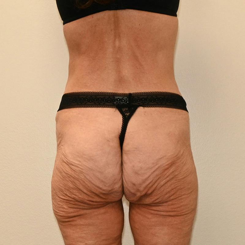 Body Lift Before & After Gallery - Patient 796213 - Image 7
