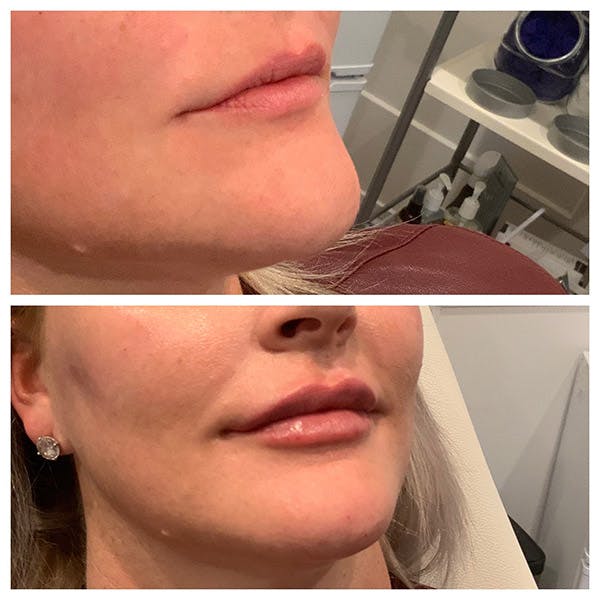 Lips Before & After Gallery - Patient 27018903 - Image 2