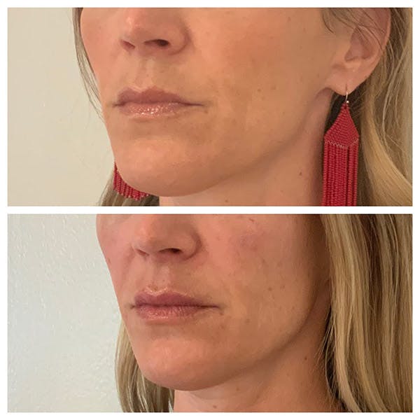 Lips Before & After Gallery - Patient 27018924 - Image 2
