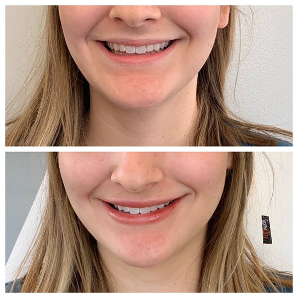 Lips Before & After Gallery - Patient 27018932 - Image 1