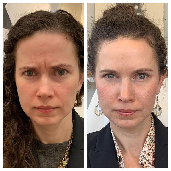 Neuromodulators Before & After Gallery - Patient 27018935 - Image 2