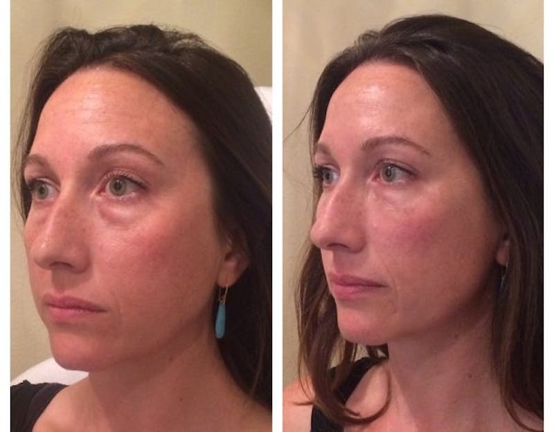 tear trough filler results