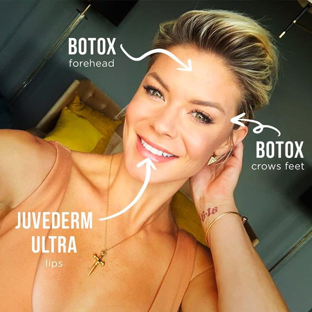 woman who got facial fillers