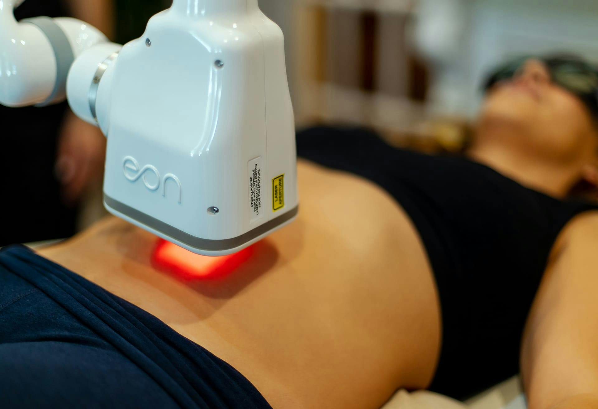A woman getting a laser treatment on her stomach