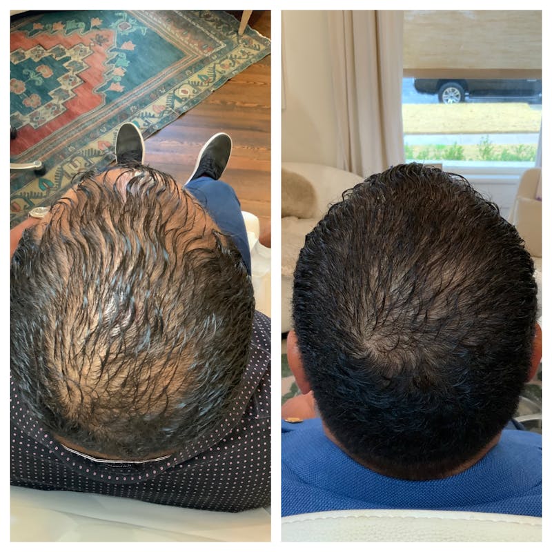 exosome therapy patient results