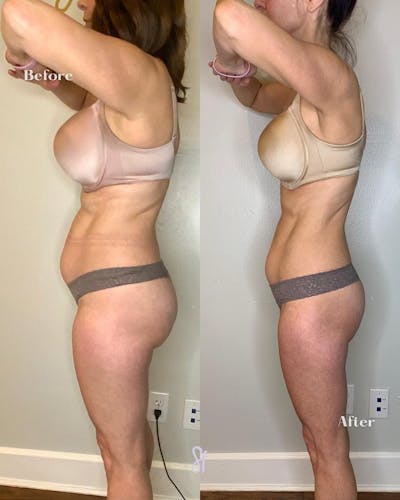 GLP-1 - Weight Loss Before & After Gallery - Patient 157580380 - Image 1